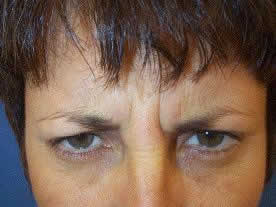 botox1