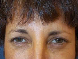 botox2