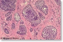 carcinoma1