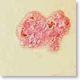 carcinoma4