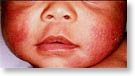 eczema1
