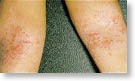 eczema3