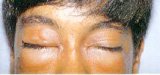 alergia_medicamentos1