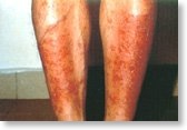dermatite_contato2