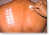 dermatite_contato3