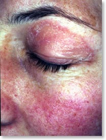 dermatomiosite1