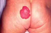 hemangioma1