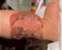 hemangioma3