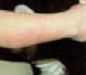 hemangioma4