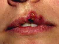 herpes_simples1