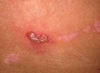 herpes_simples2