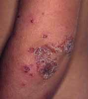 impetigo1