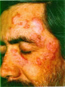 lupus1