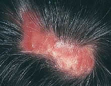 lupus2