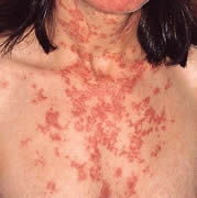 lupus3