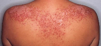 lupus4