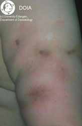 lupus5