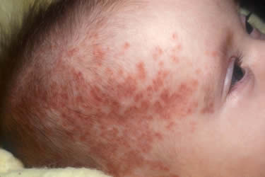 lupus6