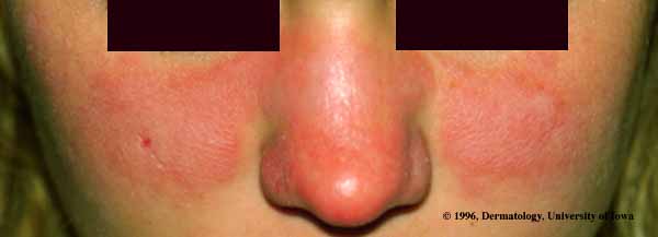 lupus7