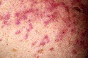 miliaria1