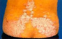 psoriase1