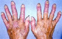 psoriase2