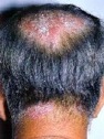 psoriase3