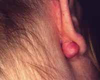 queloide1