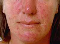 rosacea1