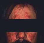 rosacea2
