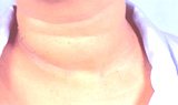 tumor2